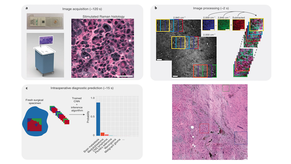 Information related to a test powered by deep learning that diagnoses tumor samples in only a few minutes